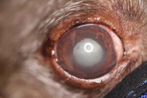 Lens-induced uveitis OD from a diabetic cataract