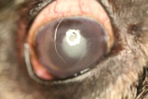 Lens-induced uveitis from a diabetic cataract after treatment