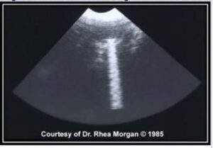 Ocular ultrasound of dog gunshot wound to OS