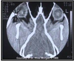 Ocular computed tomographic image of dog gunshot wound to OS