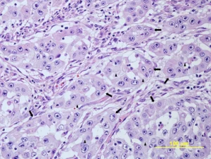 A lacrimal adenocarcinoma of the third eyelid was diagnosed based on histopathology.
